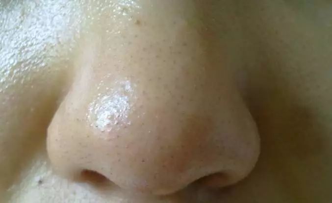 拒绝草莓鼻夹子夹出粉刺,拒绝草莓鼻毛孔粗大