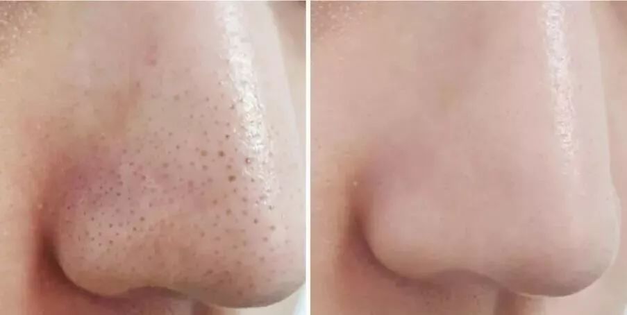 日本草莓鼻去黑头最有效的产品,byebye草莓鼻去黑头神器大揭秘