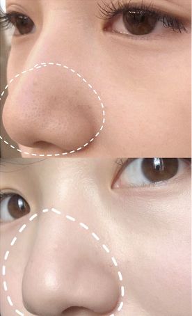 拒绝草莓鼻夹子夹出粉刺,拒绝草莓鼻毛孔粗大