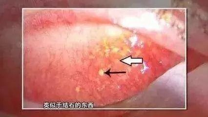 29岁女子眼睛里长满“结石”，这个习惯你竟然也有