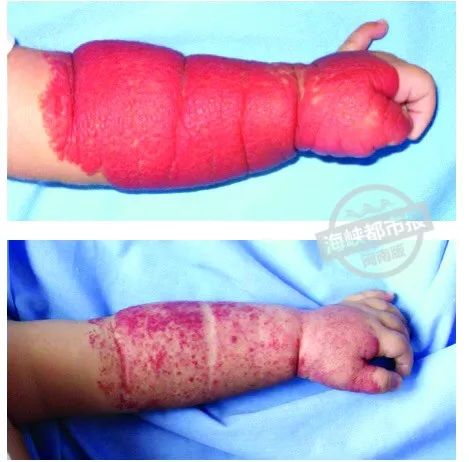 泉州家长注意！孩子身上这个“红胎记”，险些造成左眼失明