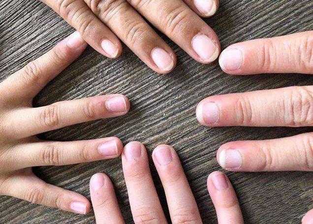 治疗灰指甲第一步去除病甲,灰指甲真菌最怕什么