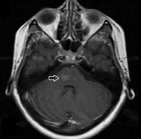 矛盾反应、Carney综合征、脑梗死、笑气中毒丨3分钟读片·第19期