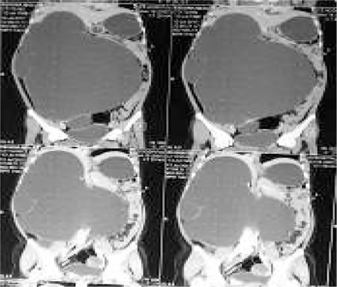 14岁先天肾积水21mm,巨大肾积水形成原因
