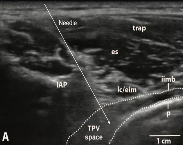 胸椎旁神经阻滞时需要穿过的韧带,胸椎旁神经阻滞超声探头位置