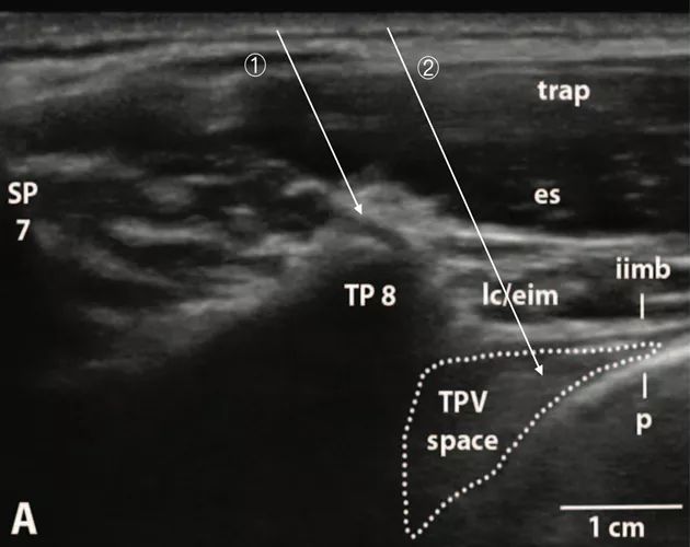 胸椎旁神经阻滞时需要穿过的韧带,胸椎旁神经阻滞超声探头位置