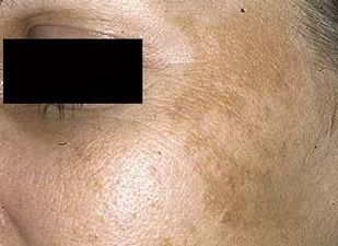 祛斑最有效是仪器还是产品,公认的祛斑第一名食物