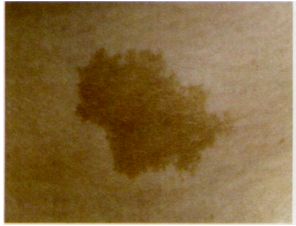 祛斑最有效是仪器还是产品,公认的祛斑第一名食物