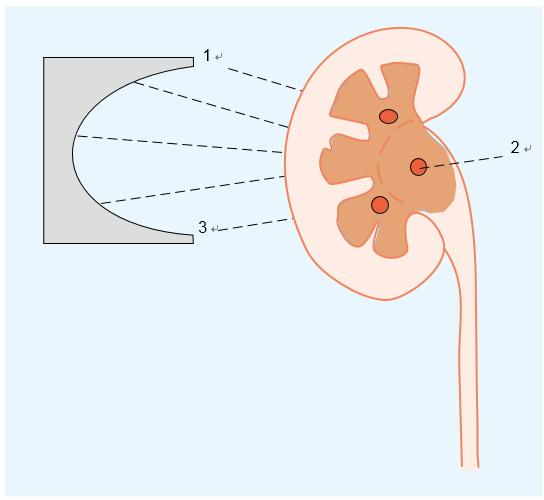 鹿角型肾结石的最佳治疗方案,肾结石鹿角形微创视频