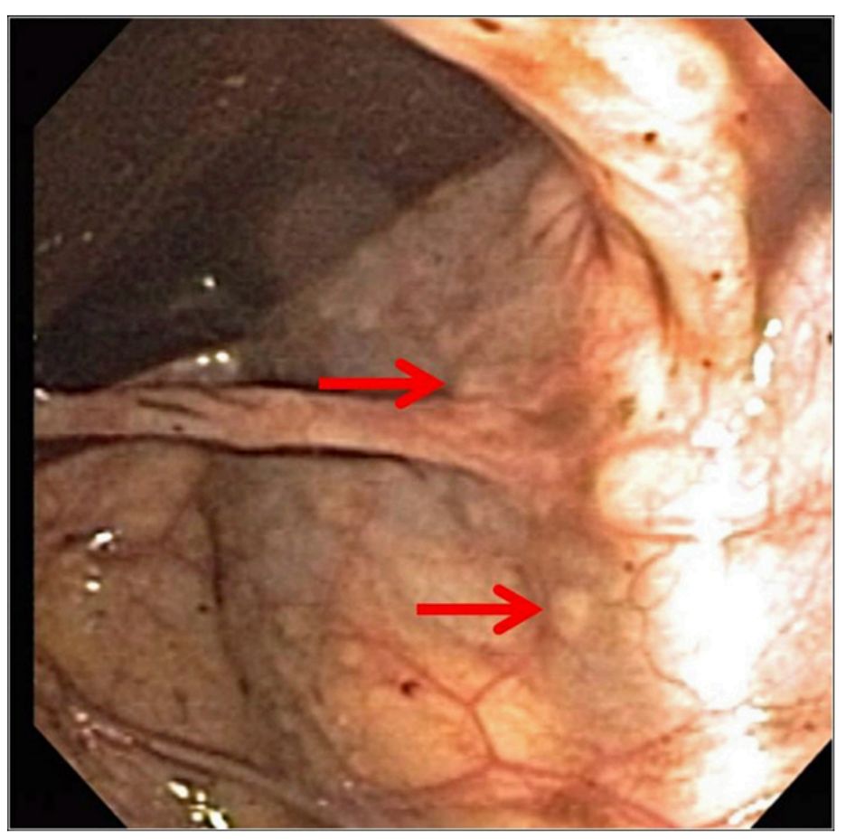 肠重复畸形严重吗,宝宝肠重复畸形怎么治疗