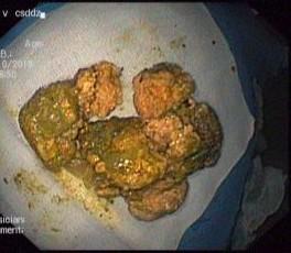 可怕!空腹吃柿子又吃红薯,六旬老人胃里取出“大柿石”