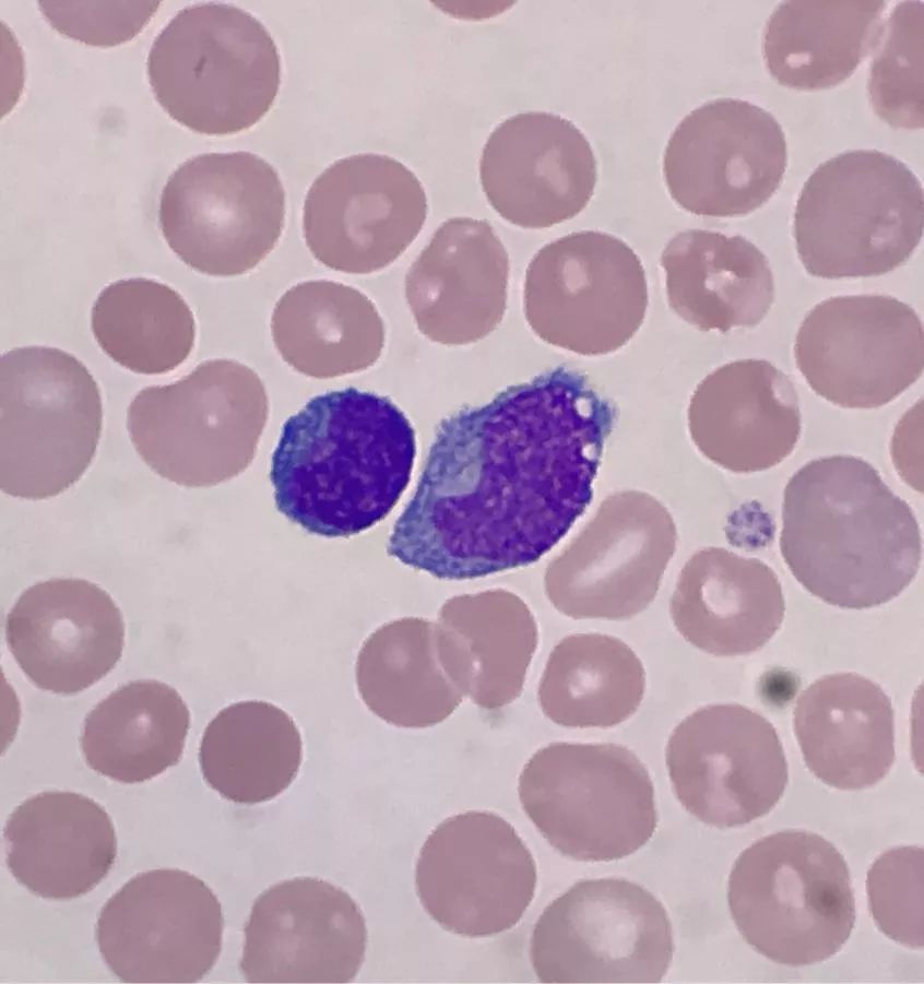 套细胞淋巴瘤胸腔侵润病例分享