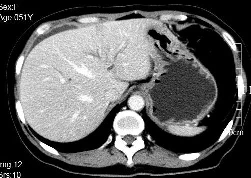 alp和ggt偏高是什么意思,alp和ggt下降意味着什么