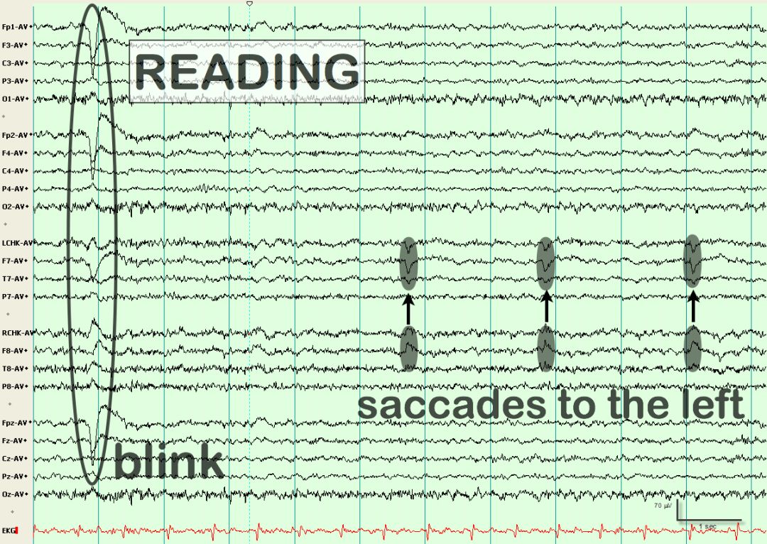 脑电图伪差图,脑电图伪差图谱
