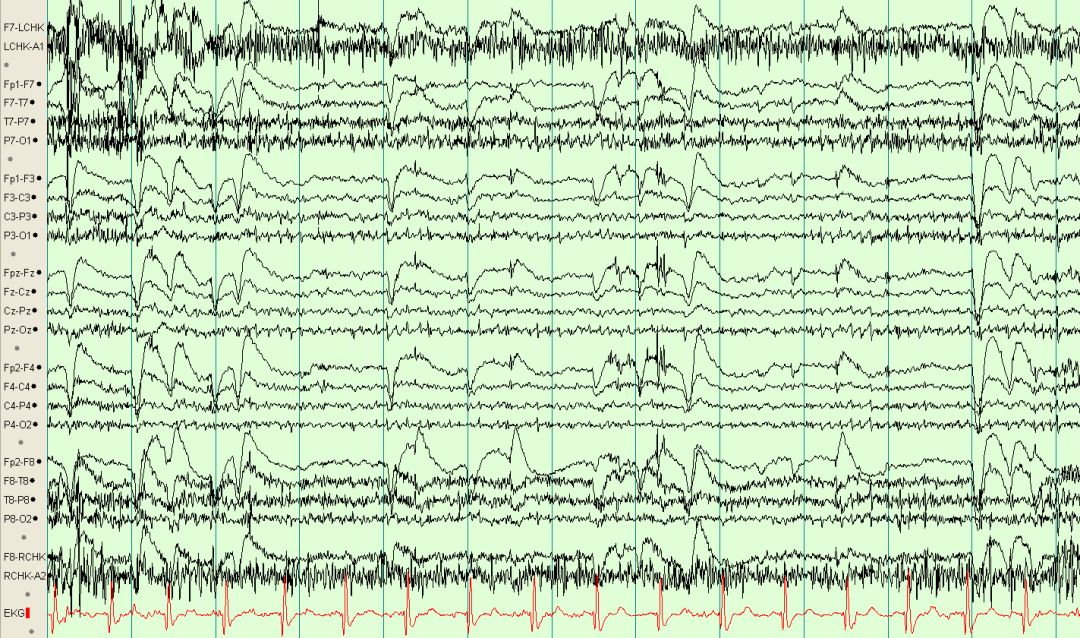 脑电图伪差图,脑电图伪差图谱