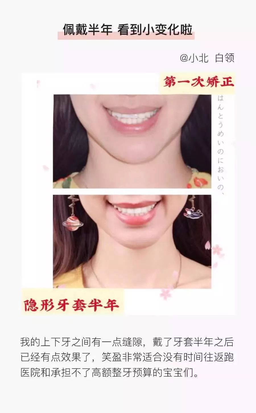 深拔牙齿矫正的潜在风险,隐形牙套的坑