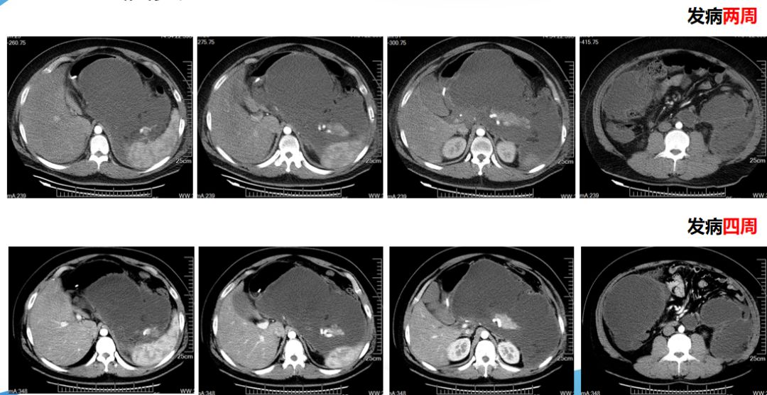 急性重症胰腺炎治疗八步骤,急性胰腺炎恐惧的护理措施