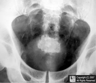 膀胱结石影像,描述膀胱结石在b超中的影像表现