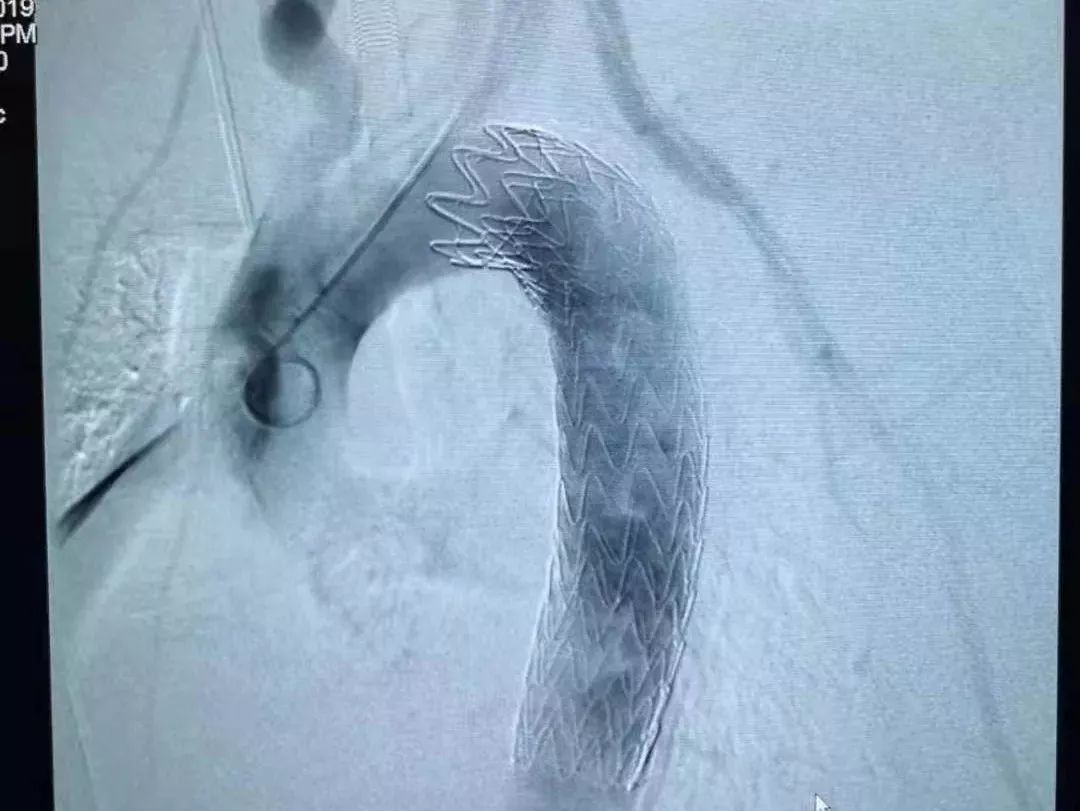 鱼刺卡住喉咙吞饭引危险,吃鱼吞了一根鱼刺开胸手术