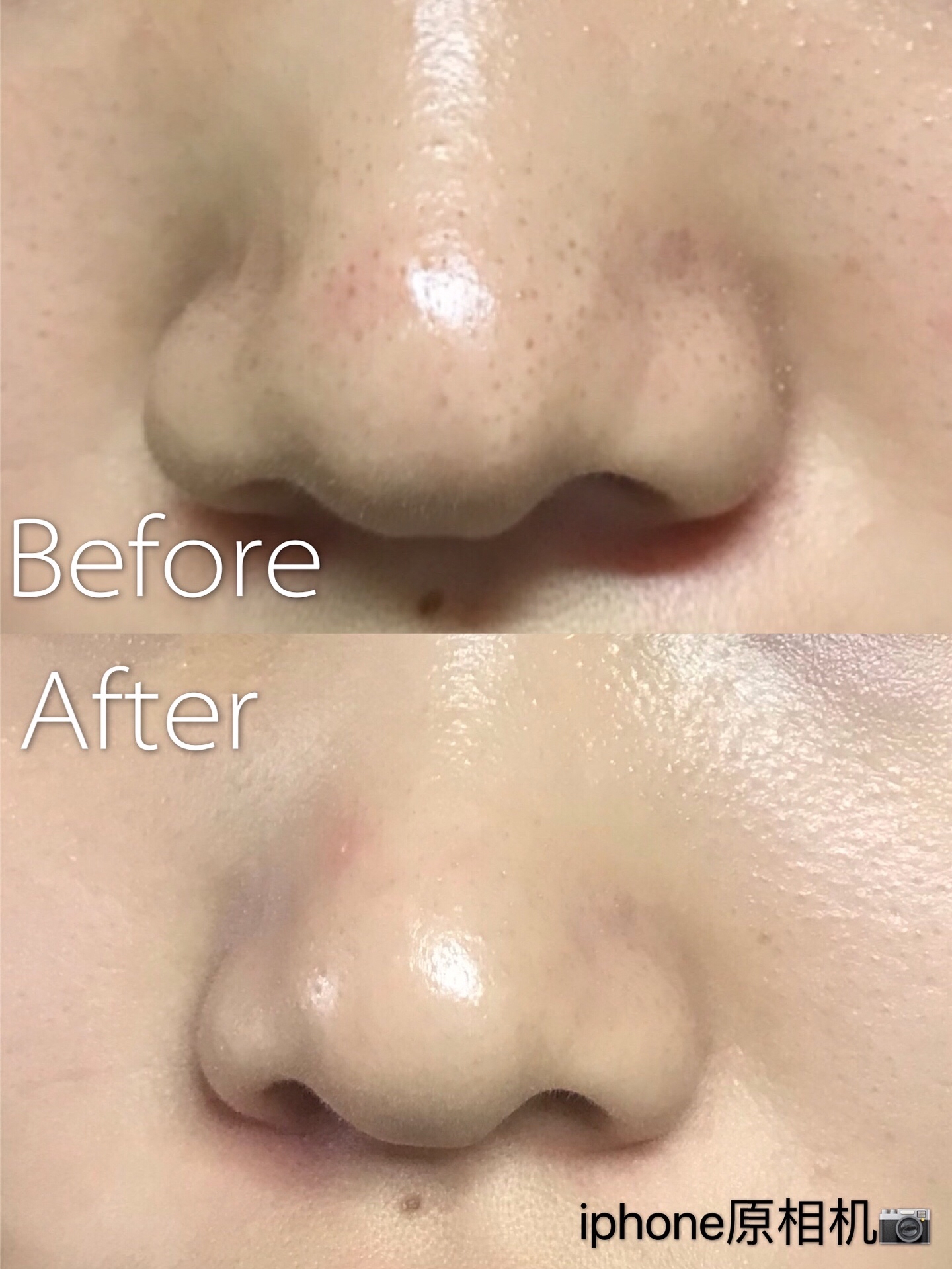 草莓鼻应该怎么去黑头,告别草莓鼻黑头神器拯救你的颜值