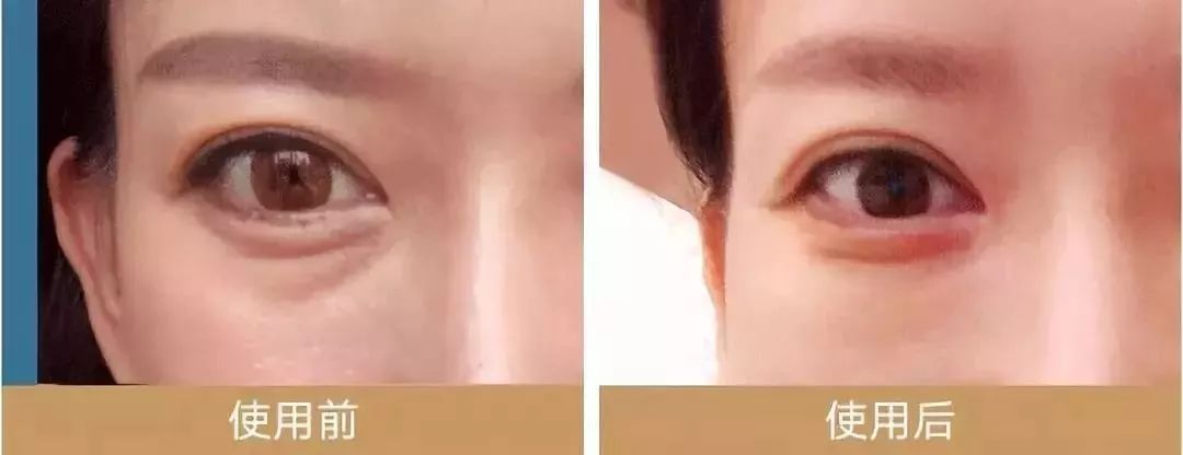 马应龙紧致型眼膜,马应龙眼膜视频