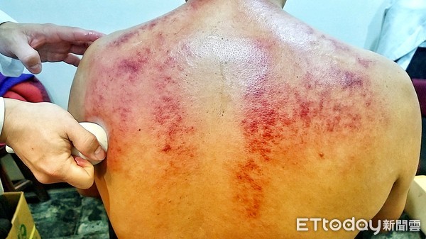 中医刮痧学注意事项,中医基础知识自学入门刮痧