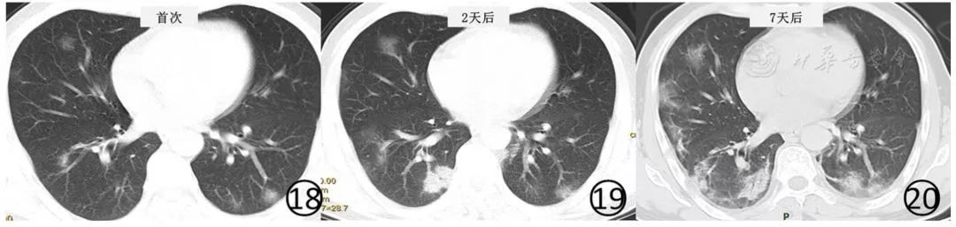 新冠肺炎影像演变过程,新冠肺炎胸部影像学特点有哪些