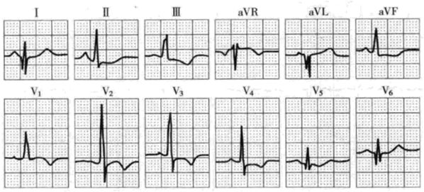 扩张型心肌病用什么消融,梗阻性肥厚性心肌病开胸手术恢复