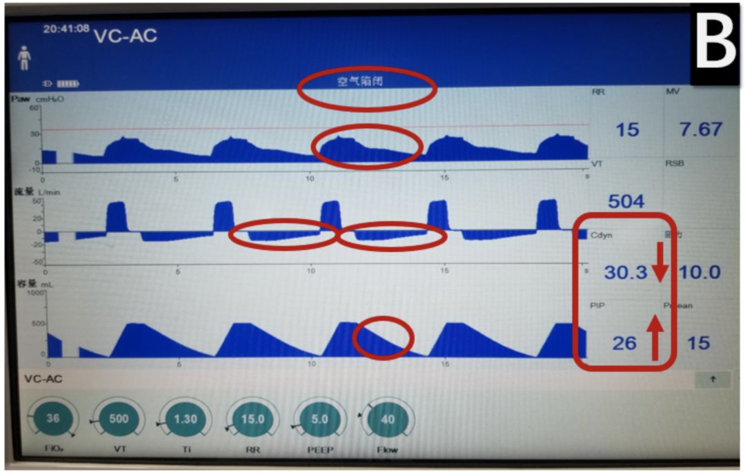 新型冠状病毒感染诊治指南,新型冠状病毒肺炎危重治疗原则