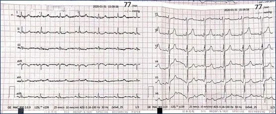 一度房室传导阻滞是怎么得的,三度房室传导阻滞最简单看法
