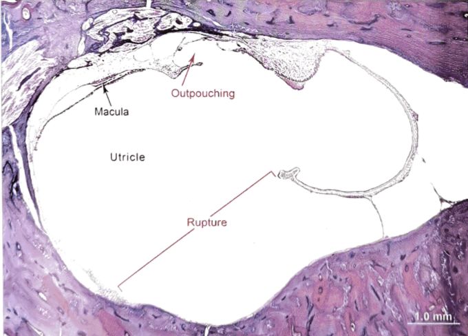梅尼埃病深度解析,梅尼埃病病理解剖