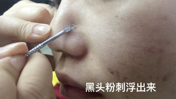 10鍒嗛挓娓呴櫎榛戝ご绮夊埡,榛戝ご绮夊埡鎸ゅ帇娓呯悊姣涘瓟绮楀ぇ