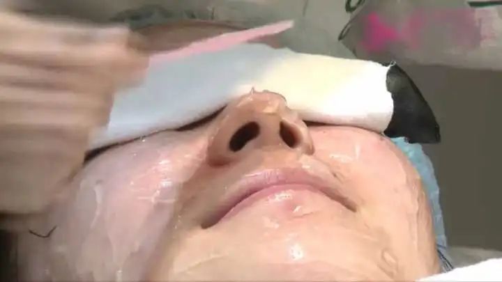 去除鼻子黑头视频大全,如何去除鼻子上的黑头12岁孩子