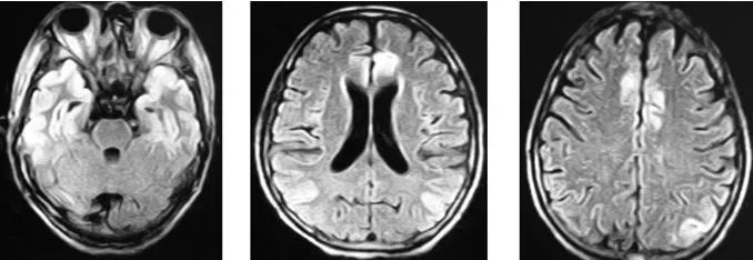 低血糖频发的症状及原因,反复低血糖病例