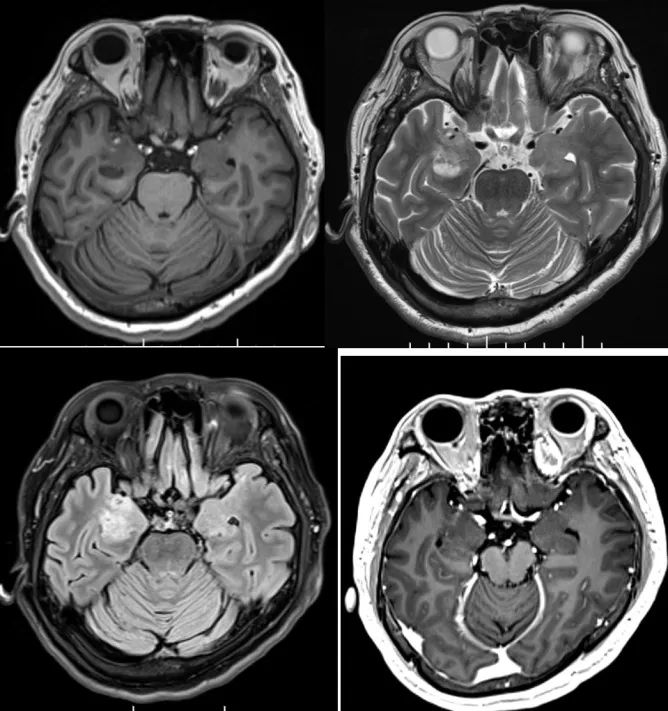 枫糖尿病、血管型梅毒、Hopkins综合征、Susac综合征丨3分钟读片·2期