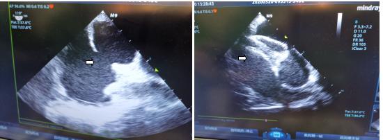 老人心脏破了个洞,高龄老人心血管破裂能恢复吗