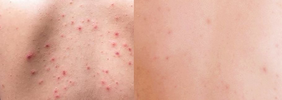 前胸鸡皮痘痘怎么处理,胸背痘痘清理