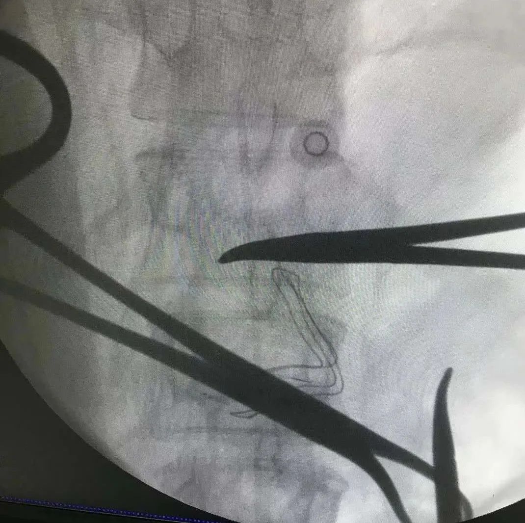 癌症吃止痛药都没用了还能活多久,癌症病人吃止疼药不管用怎么办