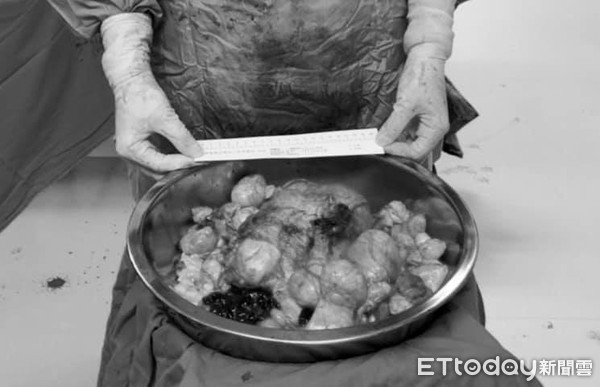 女医生做手术突然大出血,女医生做手术后大出血