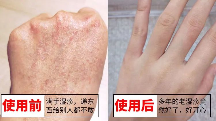 长小水泡很痒用什么中药,皮肤止痒起包用哪个药膏