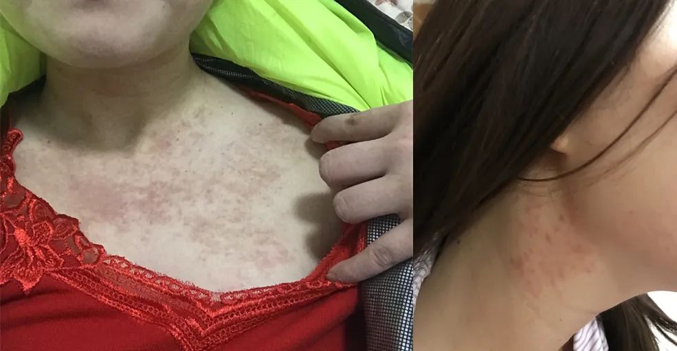 长小水泡很痒用什么中药,皮肤止痒起包用哪个药膏