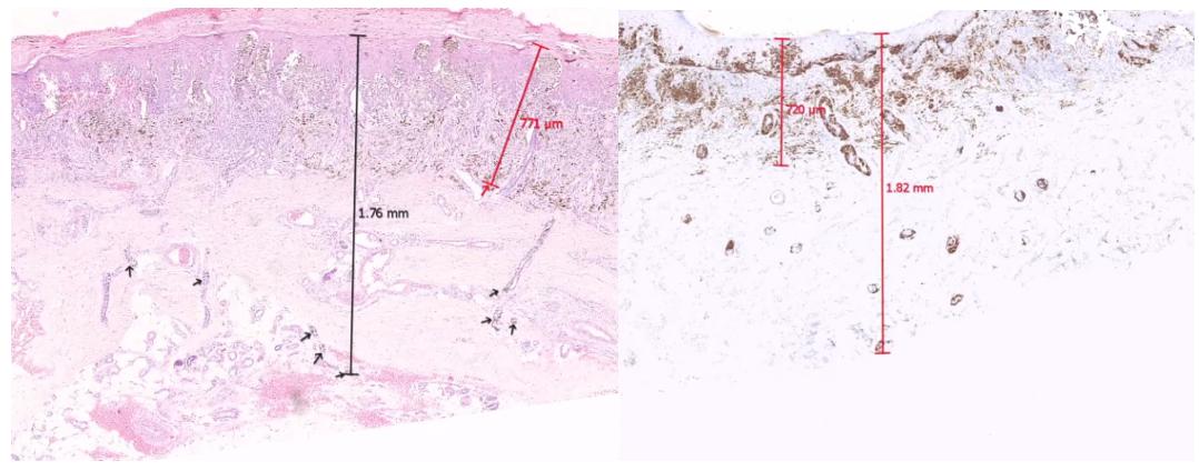 “疫时寻理”|黑色素瘤专场亮点与回顾（第五期）