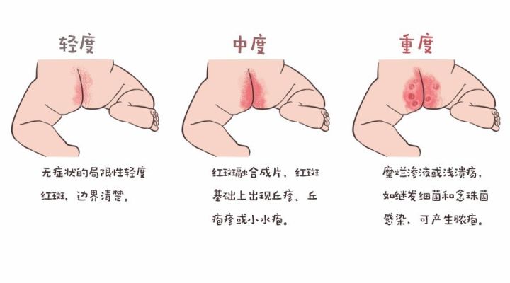 为啥放不出屁如此痛苦？为啥有的却一天屁个不停