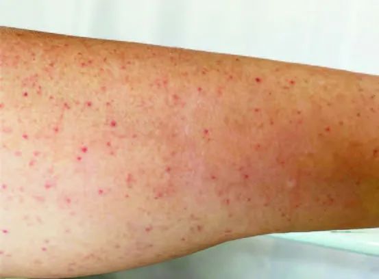 血小板减少性紫癜与mds,COVID-19抗原准吗