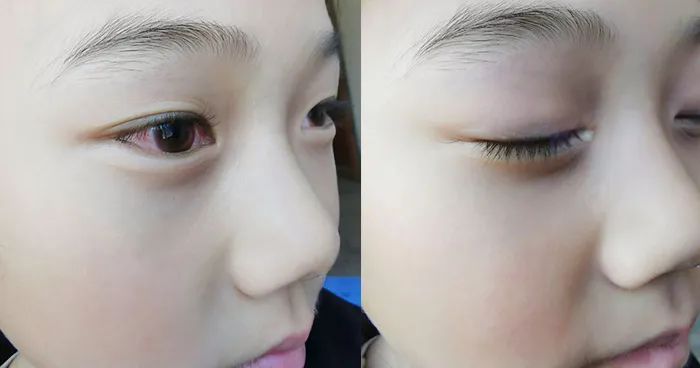 护眼蓝光过滤器,日本眼科蓝光过滤器