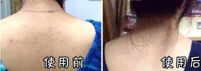 日本绿瓶的祛痘喷雾叫什么,清爽型祛痘喷雾