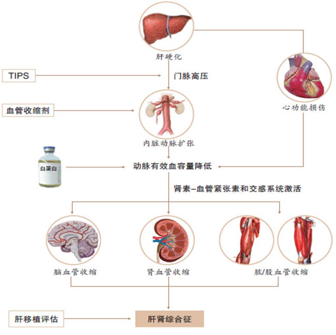 肝肾综合征的发病机制,肝硬化导致肝肾综合征机制