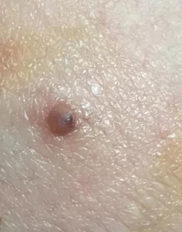 黑痣癌变的痣会很大吗,黑痣癌变一般是一个痣还是好多