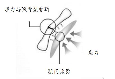 三年级学生骨折,初三开学多人骨折