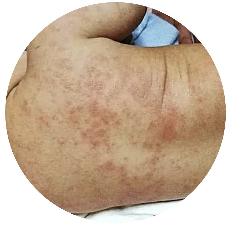 夏天预防治疗宝宝痱子的小方法,婴儿夏天防痱子用什么